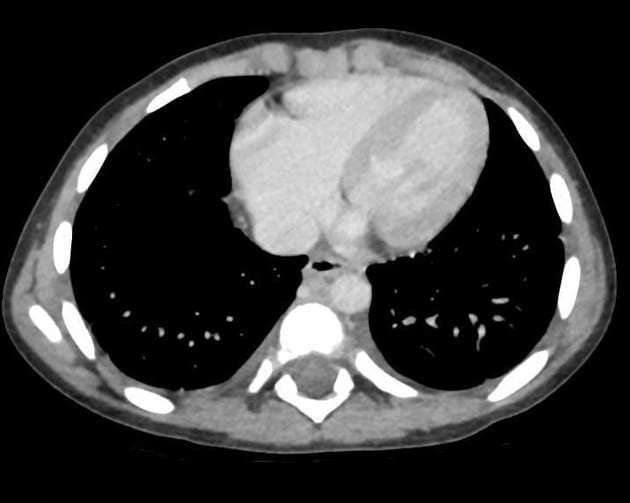Infectious mononucleosis