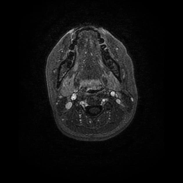 Von Hippel-Lindau Syndrome (Hội chứng Von Hippel-Lindau)