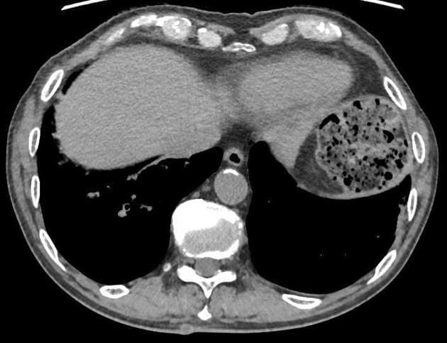 Pancreatic Ductal Adenocarcinoma Detected on Ultrasound (Ung thư biểu mô tuyến tụy (siêu âm))