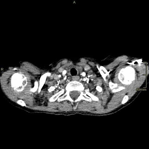Fontan circulation (CT)