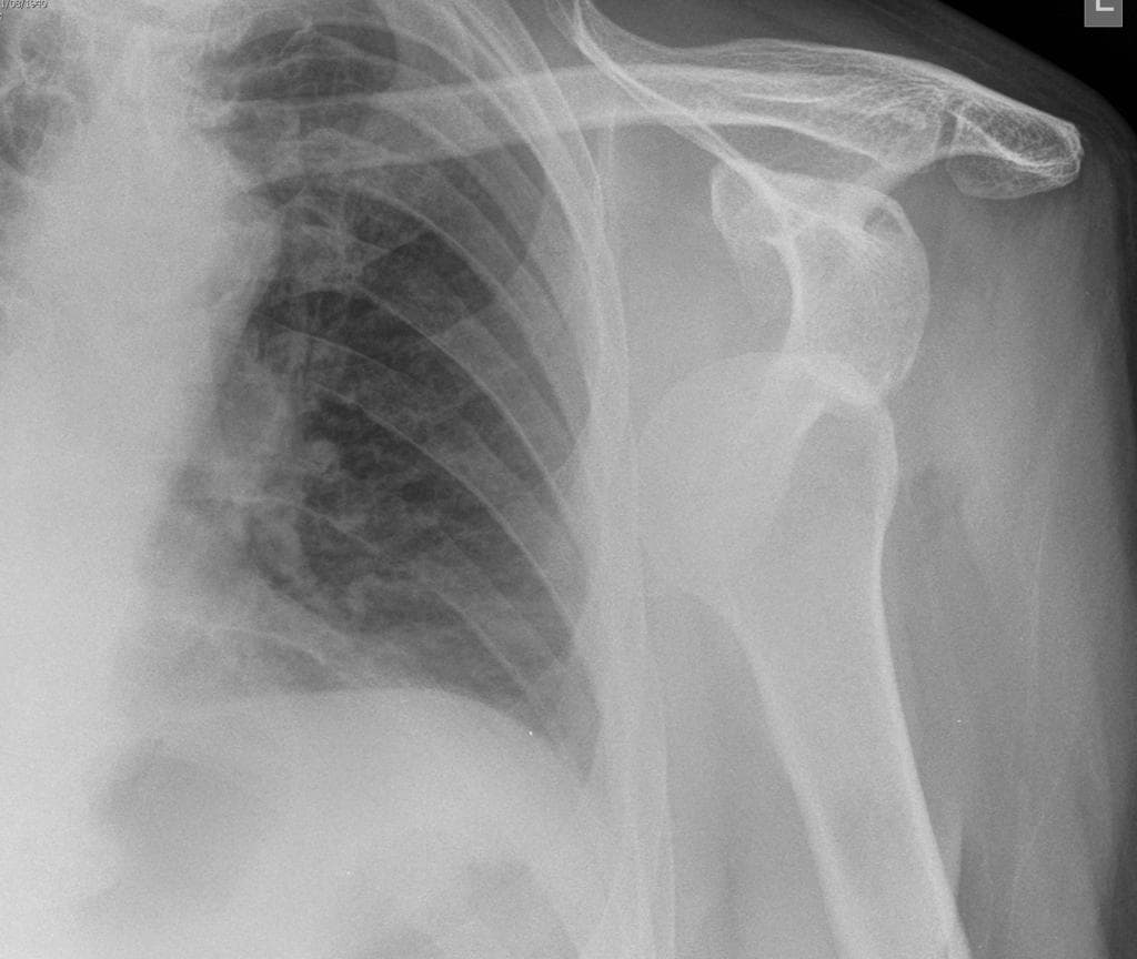 Anterior shoulder dislocation