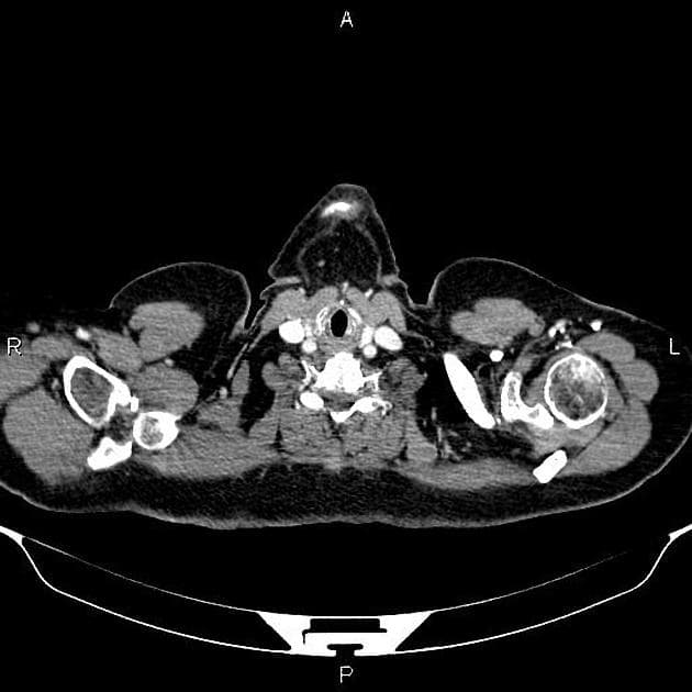 Cholangiocarcinoma with Hepatic Metastases and Portal Vein Involvement (Ung thư tế bào gan đường mật)