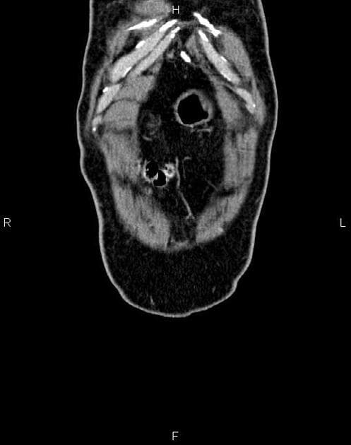 Pancreatic Cancer (Ung thư tụy)