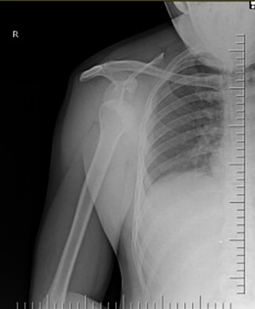 Anterior shoulder dislocation