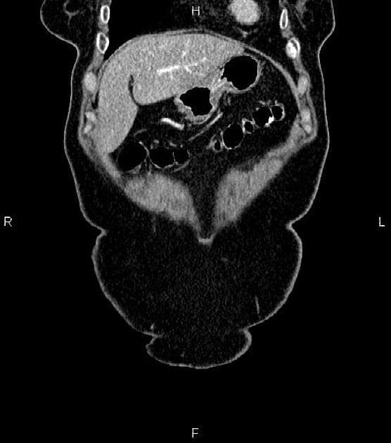 Pancreatic Adenocarcinoma with Regional Lymphadenopathy (Ung thư tụy)