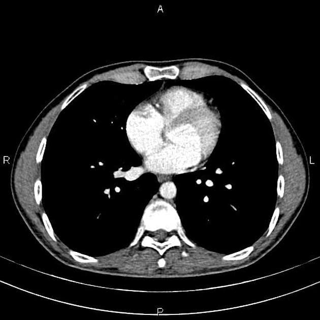 Focal Nodular Hyperplasia of the Liver (Tăng sản tuyến focale)
