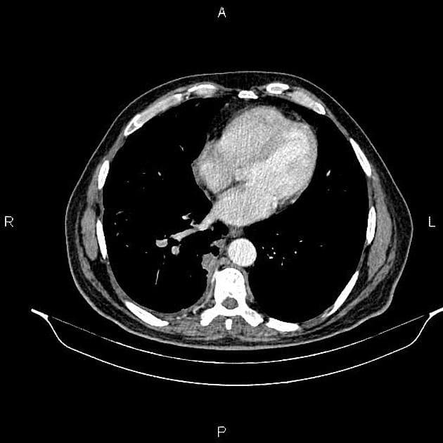 Locally Advanced Metastatic Pancreatic Cancer (Ung thư tụy di căn tiến triển tại chỗ)