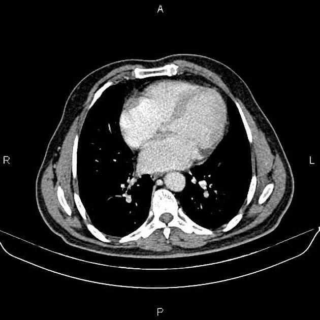 Renal Oncocytoma (U oncocytoma thận)