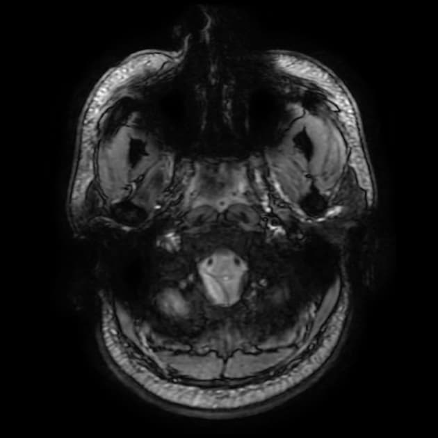 Acute Methanol Poisoning (Ngộ độc methanol cấp tính)