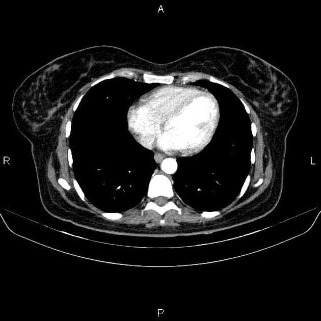 Double Duct Sign (Dấu hiệu hai ống dẫn)
