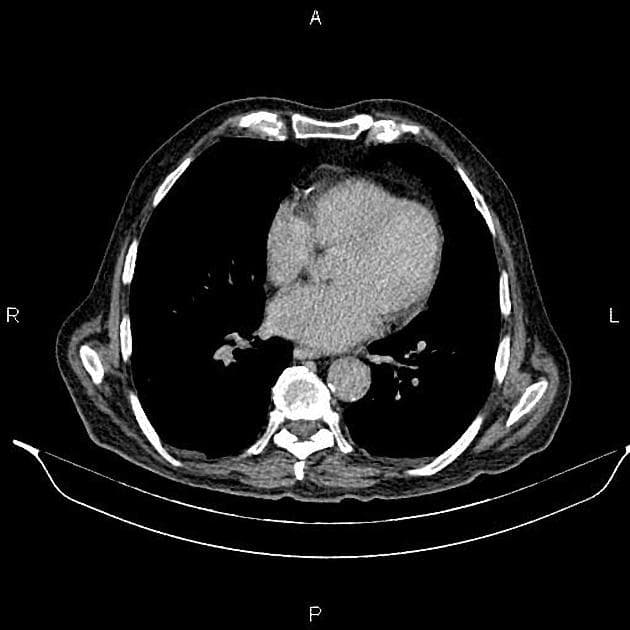 Metastatic Pancreatic Ductal Adenocarcinoma (Ung thư biểu mô tuyến ống tụy di căn)