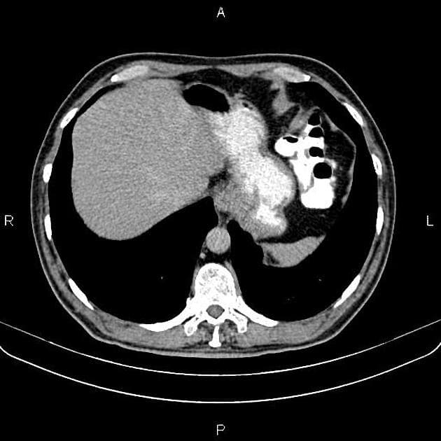 Renal Urothelial Cell Carcinoma (Ung thư tế bào biểu mô niệu quản thận)