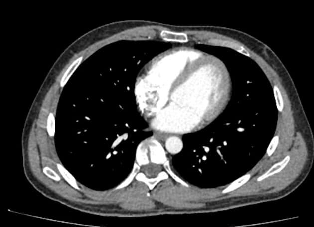 Von Hippel-Lindau syndrome (Hội chứng Von Hippel Lindau)