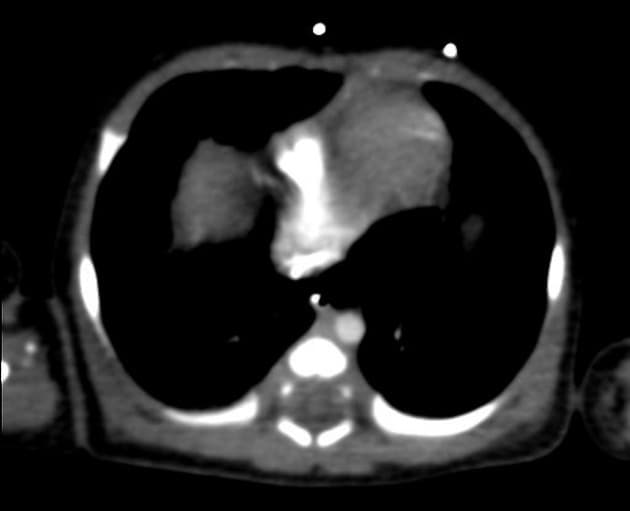Aortic tubular hypoplasia/preductal coarctation with large patent ductus arteriosus