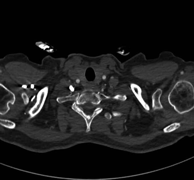 Kawasaki Disease with Thrombosed Right and Left Coronary Artery Aneurysms (Bệnh Kawasaki với các phình mạch vành trái và phải bị huyết khối)