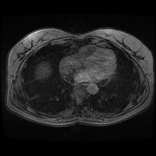 Focal nodular hyperplasia (FNH)