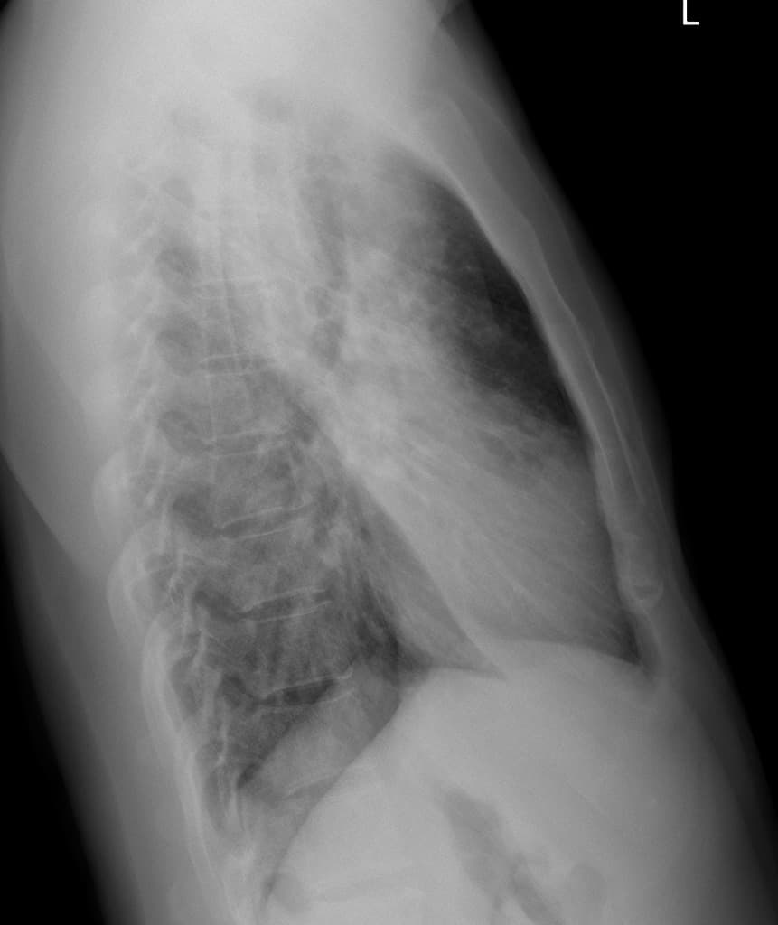 Active Pulmonary Tuberculosis (Lao phổi thể hoạt động)