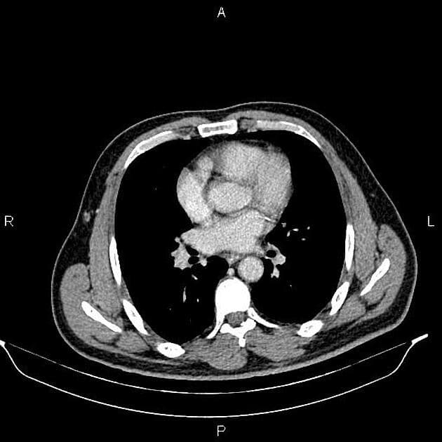 Distal Ureteral Urothelial Cell Carcinoma (Ung thư tế bào biểu mô niệu quản đoạn xa)