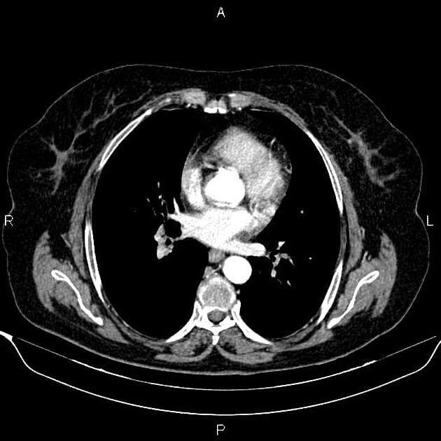 Renal Cyst - Bosniak IV (U nang thận - Bosniak IV)