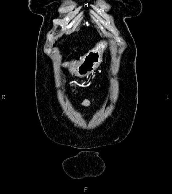 Pancreatic Adenocarcinoma (Ung thư biểu mô tuyến tụy)
