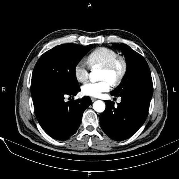 Pancreatic Adenocarcinoma Arising in the Uncinate Process (Ung thư biểu mô tuyến tụy)
