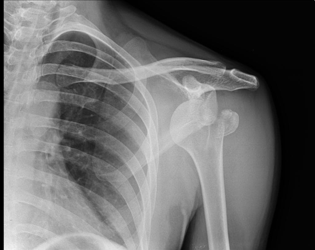Anterior shoulder dislocation with fracture of greater tuberosity of humeral head