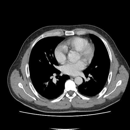 Perforated Meckel's diverticulum with enterolith