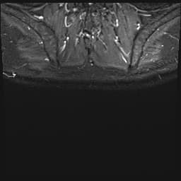 Active Sacroiliitis in Ankylosing Spondylitis (Viêm khớp cùng chậu hoạt động – viêm cột sống dính khớp)