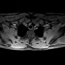 Subacute combined degeneration of the cord - enhancing
