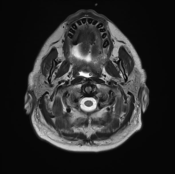 Neuromelioidosis with Multifocal CNS Involvement (Neuromelioidosis)