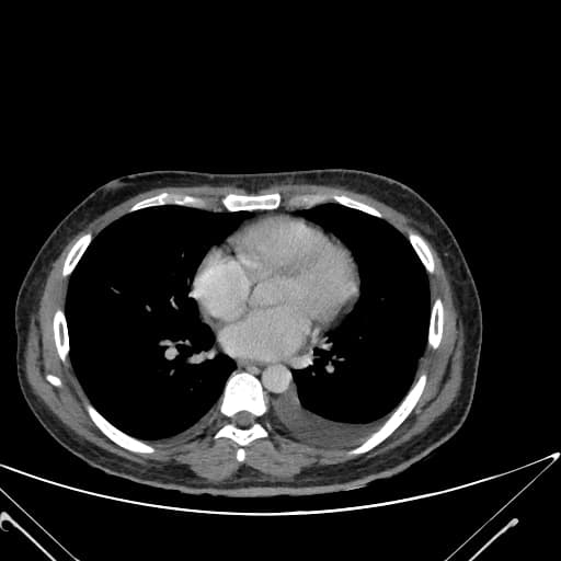 Lymphonodocolic Fistula Secondary to Abdominal Tuberculosis (Dò hạch ruột kết thứ phát do lao bụng)
