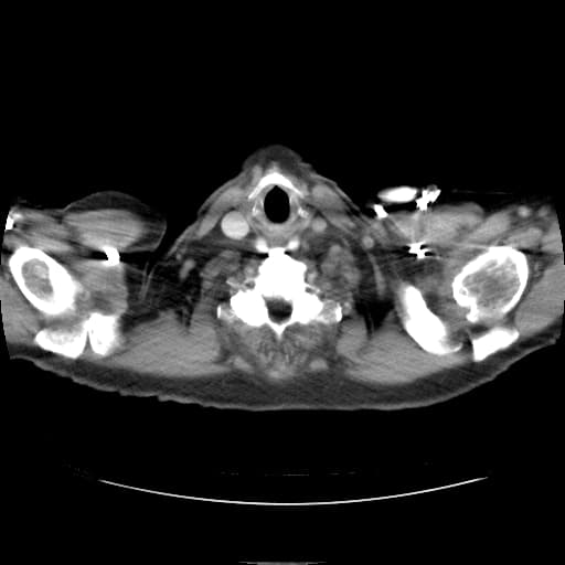 TAVI - valve embolization and migration
