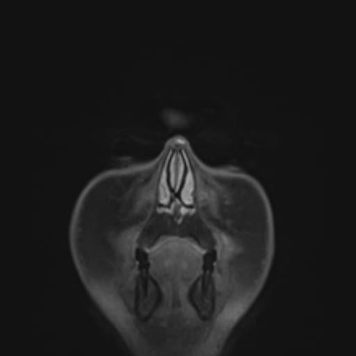 Multicentric glioblastoma - IDH-wildtype