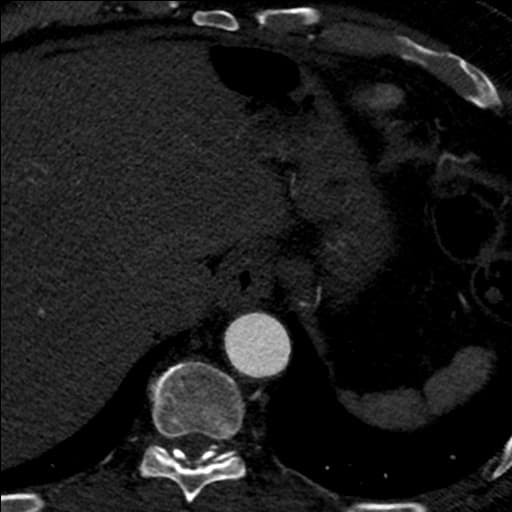 Left atrial myxoma