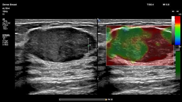 Fibroadenoma (breast)