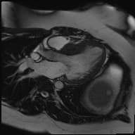 Septal hypertrophic cardiomyopathy with systolic anterior motion (SAM) of the mitral valve