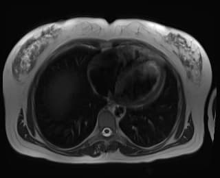 Hemorrhage into hepatic adenoma