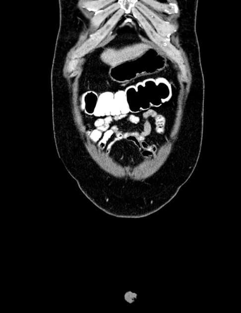 Epiploic Appendagitis (Viêm thừa mạc nối)