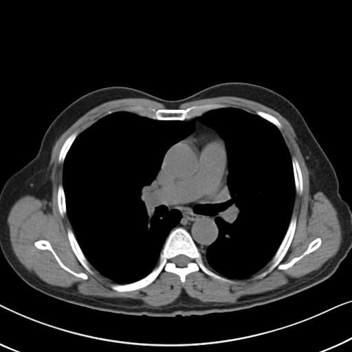 Intestinal non-rotation with gangrenous appendicitis