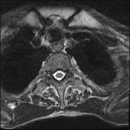 Pathological dens fracture