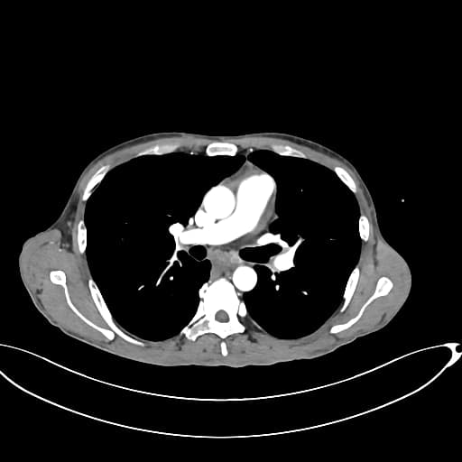 Complicated indirect inguinal hernia