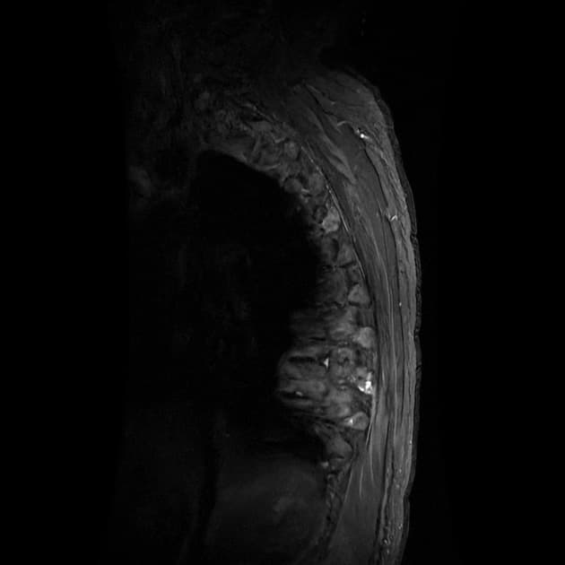 Vertebral metastases with atypical fluid-fluid levels