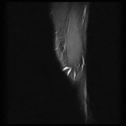 Iliotibial Band Friction Syndrome (Hội chứng cọ xát dây chằng vành đùi – chày)