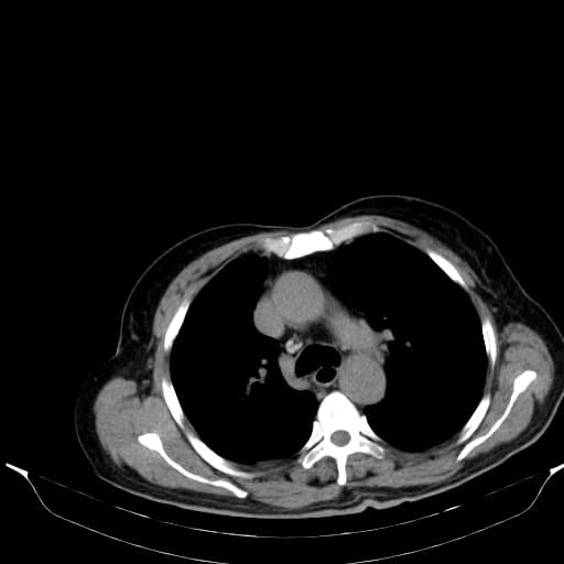 Hepatocellular carcinoma with tumor thrombosis of inferior vena cava