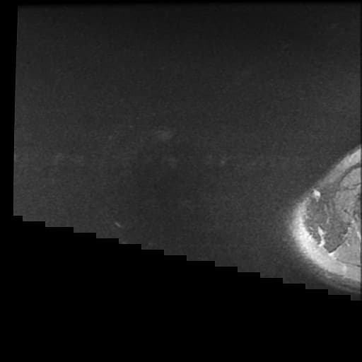 Septic Arthritis of the Acromioclavicular Joint with Extensive Soft Tissue and Muscular Involvement (Viêm khớp nhiễm trùng – khớp cùng đòn mỏm cùng (septic arthritis - acromioclavicular joint))