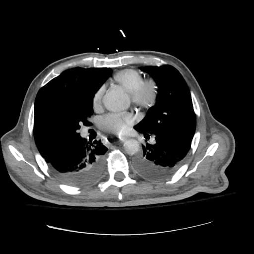 Metastatic esophageal adenocarcinoma