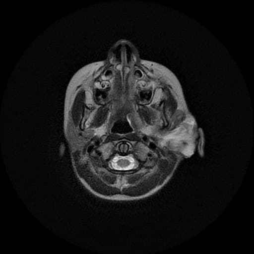 Temporal bone rhabdomyosarcoma with leptomeningeal metastases