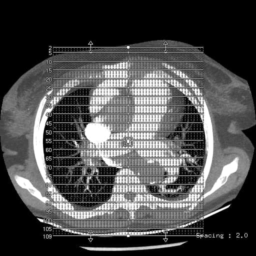 Pulmonary artery embolism
