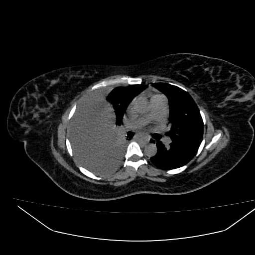 Hepatic Hematoma in HELLP Syndrome (Khối máu tụ gan trong hội chứng HELLP)