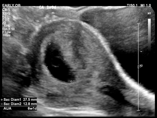 Fetal Bradycardia on Dating Ultrasound (Nhịp tim thai chậm (siêu âm xác định tuổi thai))